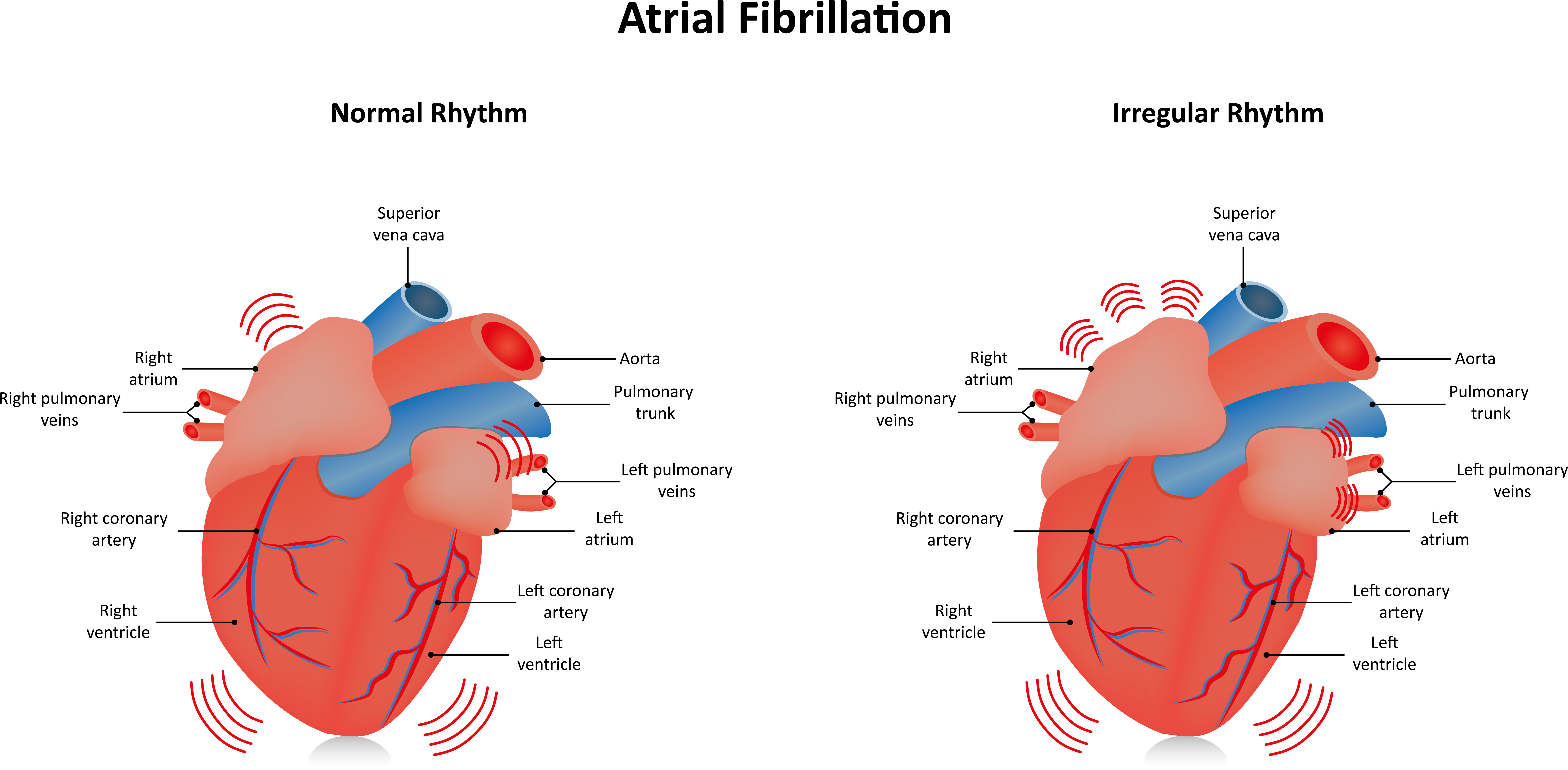 afib-sleep-apnea-and-its-effect-on-the-body