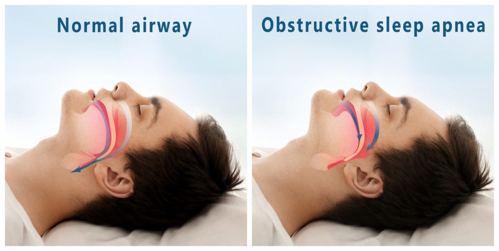 learn-more-about-sleep-apnea